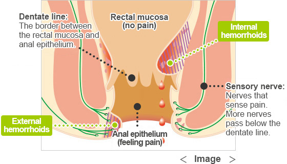 2 types of hemorrhoids you should know.