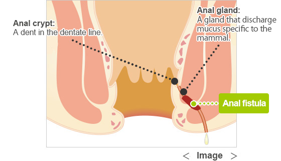 Anal fistula forming pus tunnels