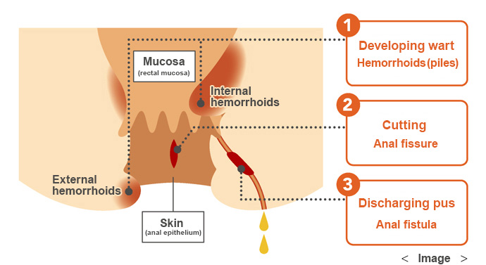 About a disease called "hemorrhoids"