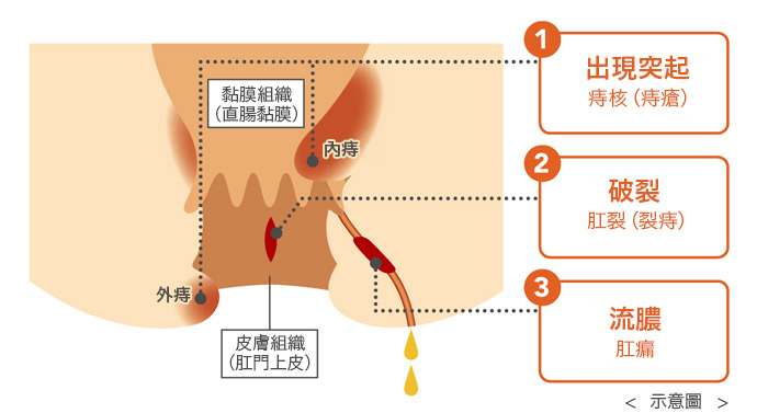 「臀部痛」是痔瘡的訊號！依照疼痛及症狀選擇合適的護理方式！！