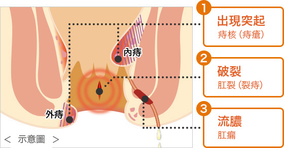 痔瘡大致分3種