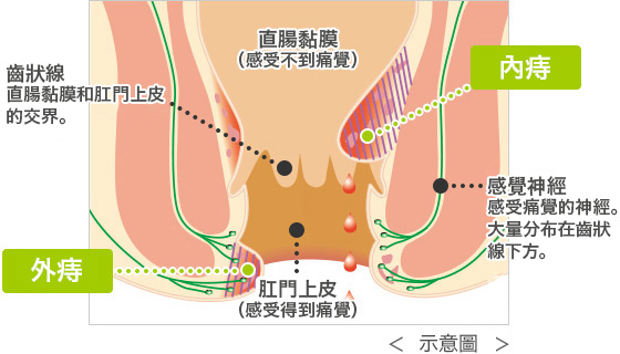 詳細了解兩種痔核