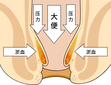 痔疮的主要原因是什么？