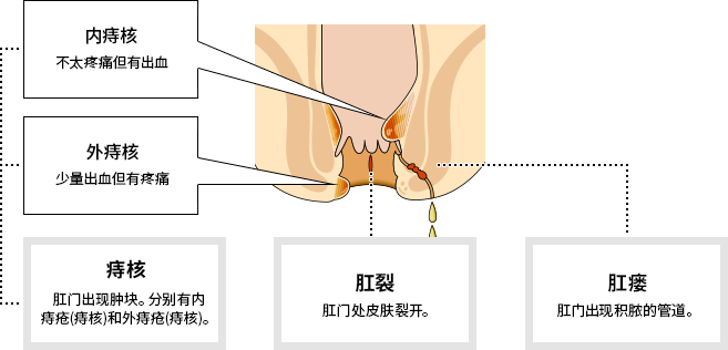 痔疮大致分为3种类型