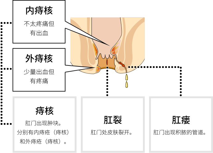 痔疮大致分为3种类型