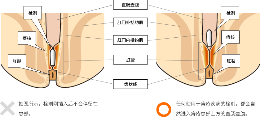 栓剂并非停留在患部