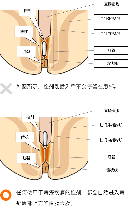 栓剂并非停留在患部