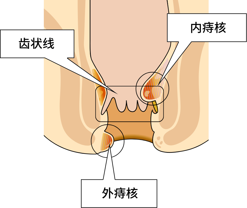 肛门出血但不痛。是痔疮吗？