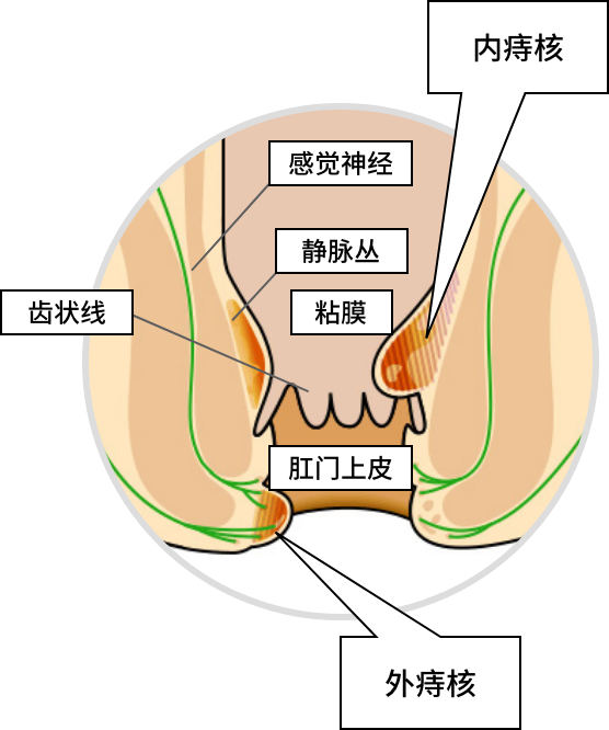 痔疮(痔核)