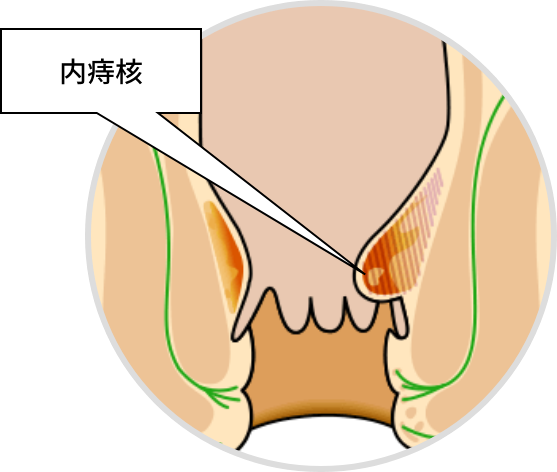 痔核（内痔核）的主要症状