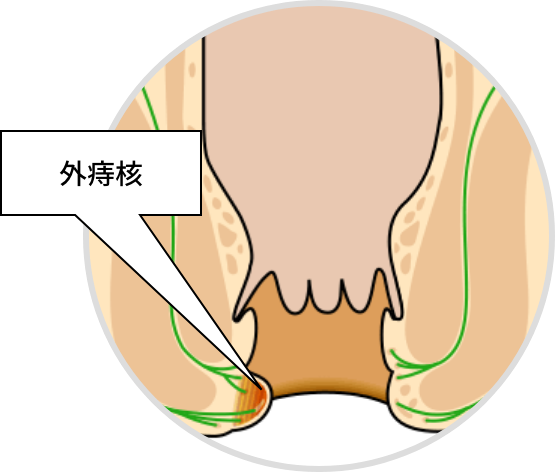 痔核（外痔核）的主要症状