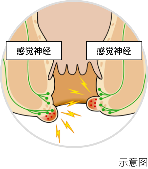 血栓性外痔核