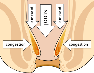 What are the main causes of hemorrhoids?