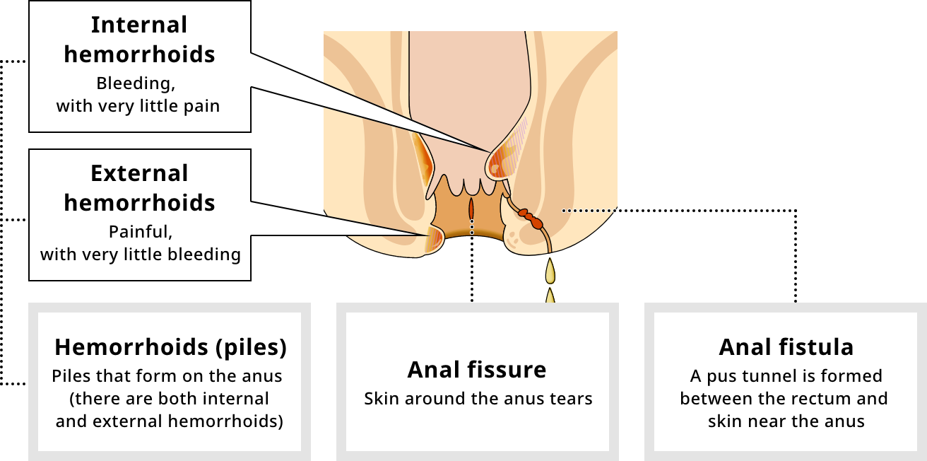 The 3 major types of hemorrhoids