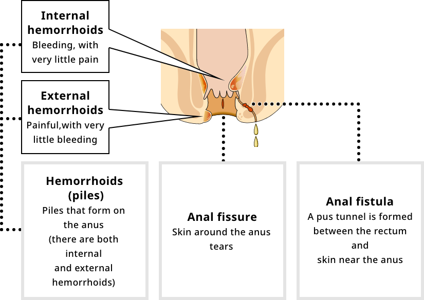 The 3 major types of hemorrhoids