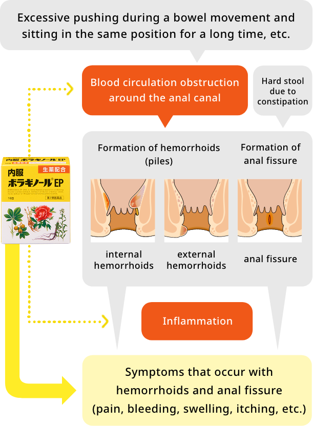 Image of an oral drug for hemorrhoids containing herbal medicine
