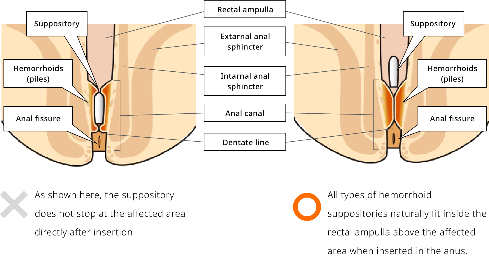 Image of the suppository does not stop at the affected area.