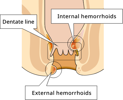 Blood is dripping out, but I don't feel pain. Is this hemorrhoids?