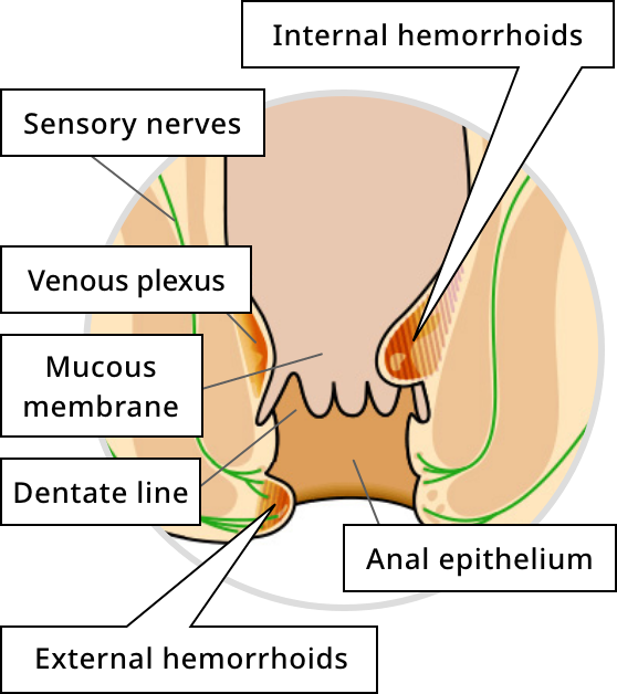 Image of blind piles (hemorrhoids