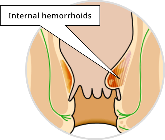 Main symptoms of internal hemorrhoids