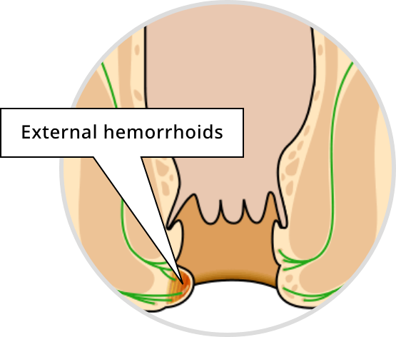 Main symptoms of external hemorrhoids