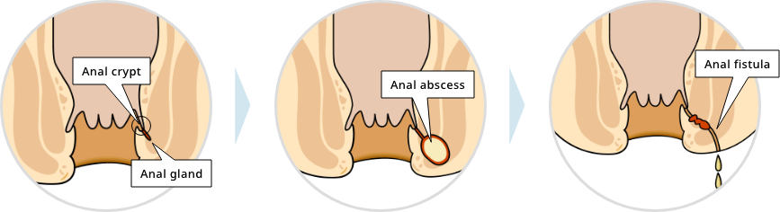 A tunnel between the rectum and anus?!