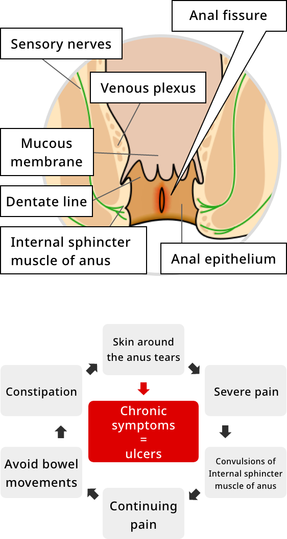 Image of anal fissure