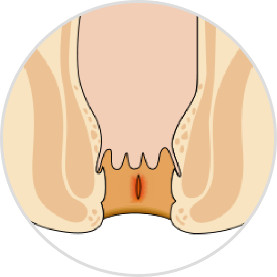 Main symptoms of anal fissure