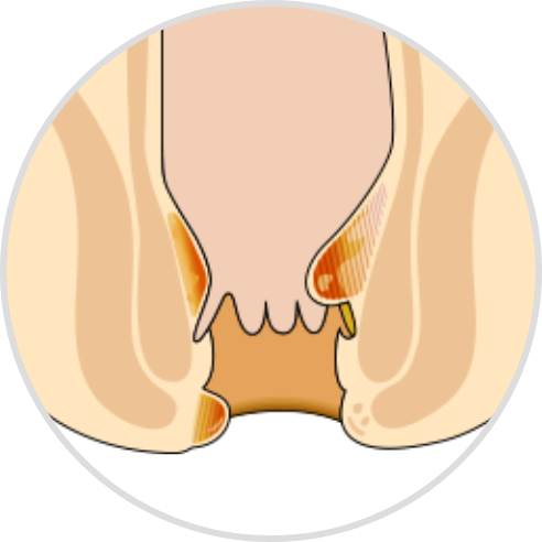 Characteristics of hemorrhoids (piles)