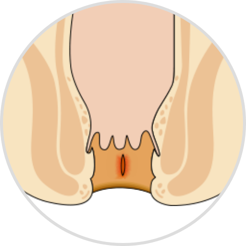 anal fissure