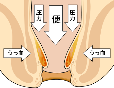 痔になる主な原因は？