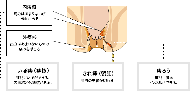 痔疮大致分为3种类型