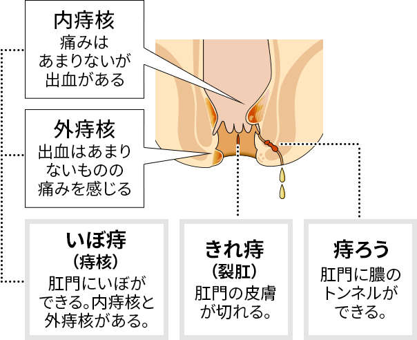 痔疮大致分为3种类型