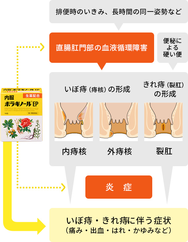 内 痔核 かゆみ