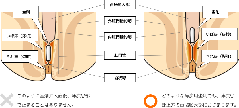 坐剤は患部に止まるものではありませんのイメージ図