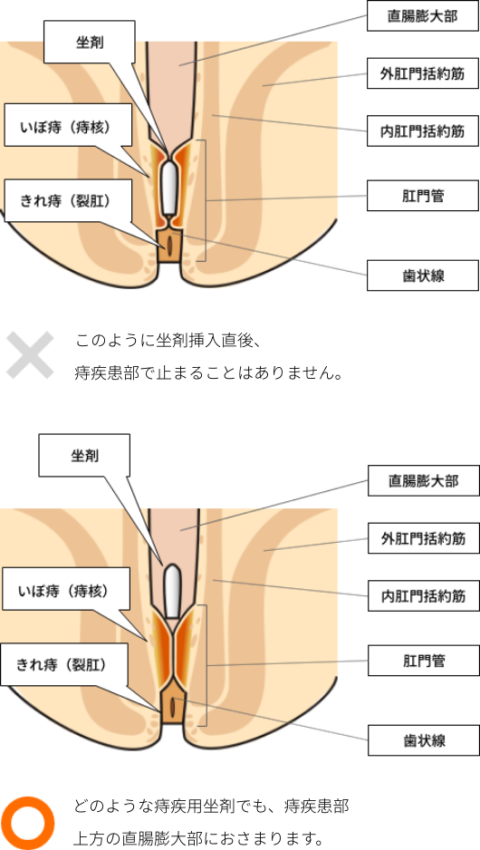 ボラギノール ステロイド