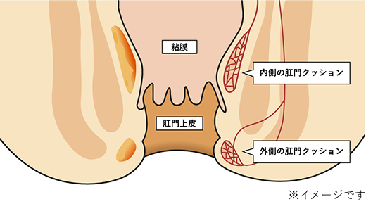 肛門クッション