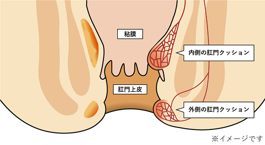 肛門クッション うっ血