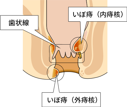 血がポタポタ出るが痛みはない。これって痔？