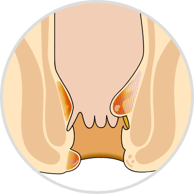 hemorrhoids (piles)