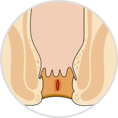 anal fissure