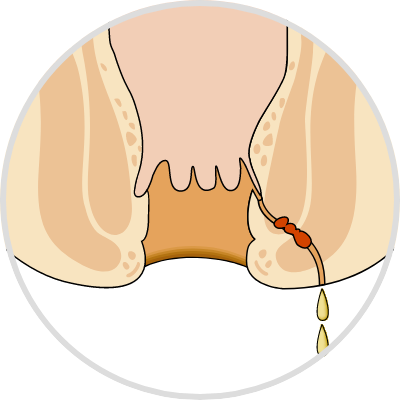 Anal fistula