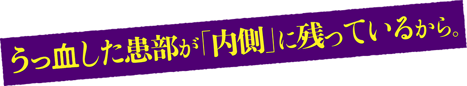 うっ血した幹部が「内側」に残っているから。