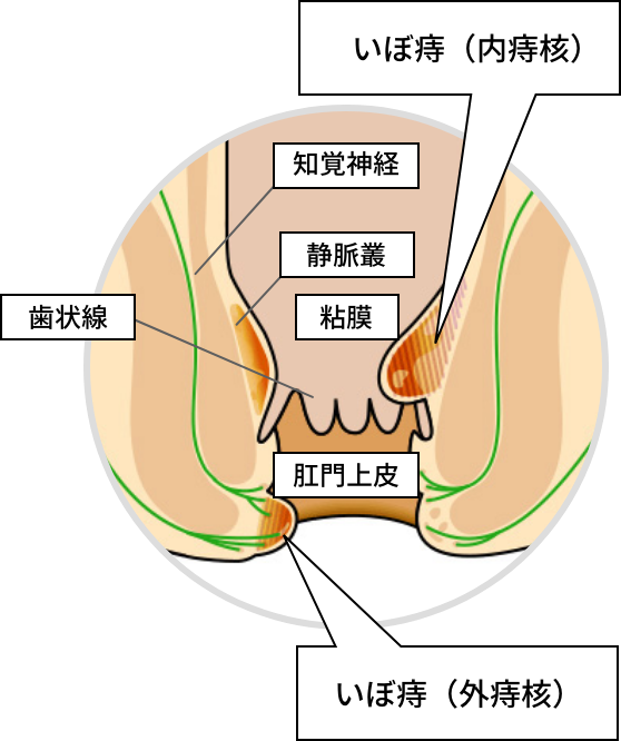 いぼ痔（痔核）のイメージ図