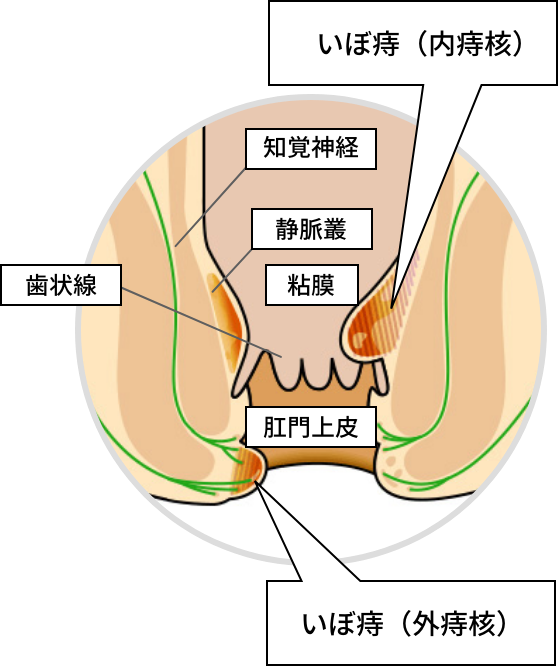 痔疮(痔核)