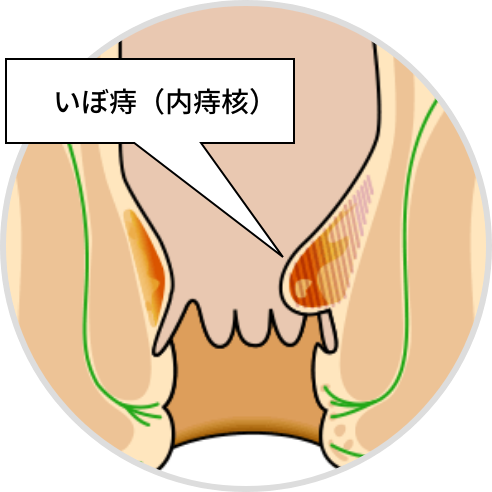 痔核（内痔核）的主要症状