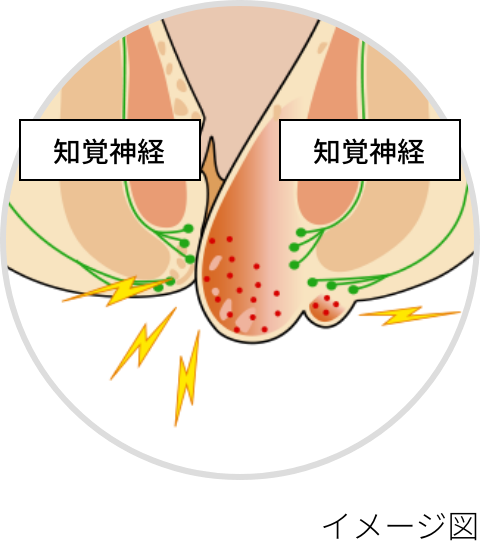 嵌頓（かんとん）痔核のイメージ図