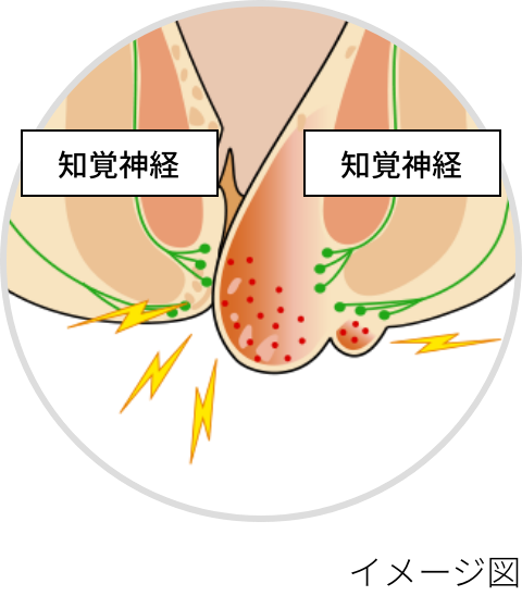 嵌顿痔核