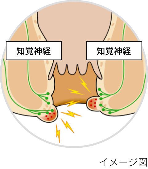 血栓性外痔核のイメージ図