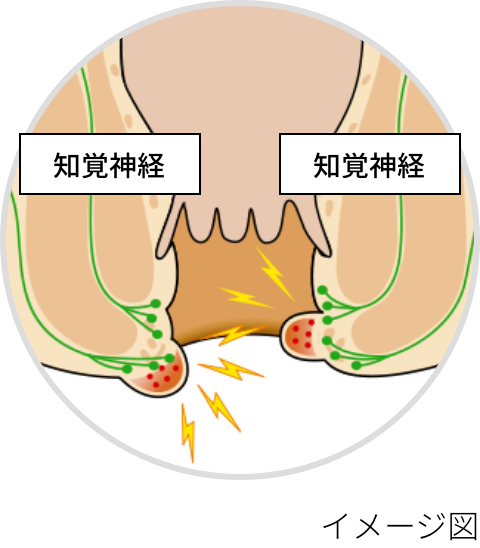 血栓性外痔核